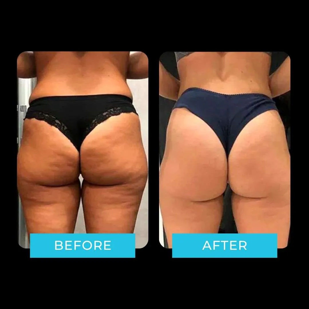 Résultat électrostimulation avant / après — raffermissement et anti-cellulite